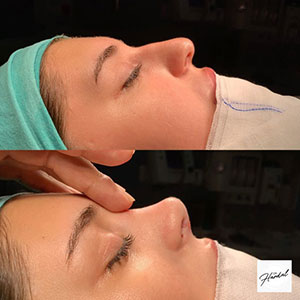 before-after