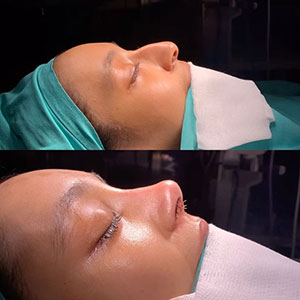 before-after