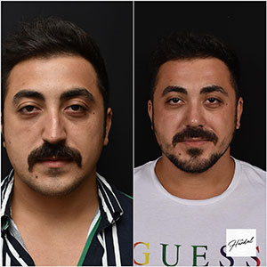 before-after