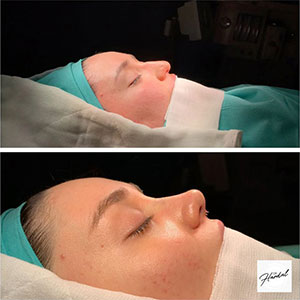 before-after