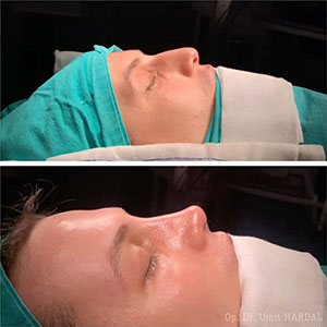 before-after