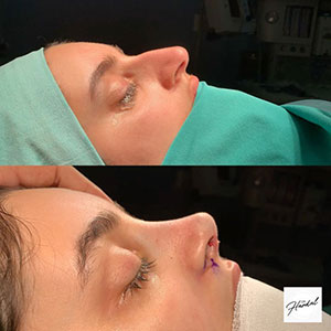 before-after