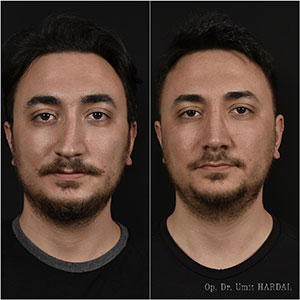 before-after